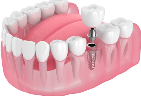 Cấy ghép implant